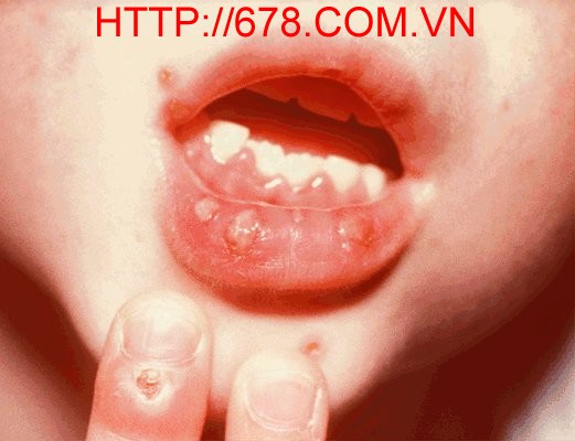 Bệnh nhiễm Herpes simplex